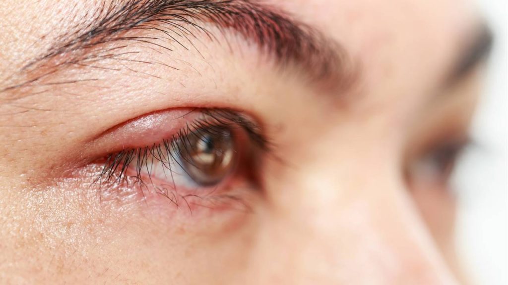 Why styes come out and how to cure them quickly with natural remedies