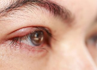 Why styes come out and how to cure them quickly with natural remedies Why styes come out and how to cure them quickly with natural remedies