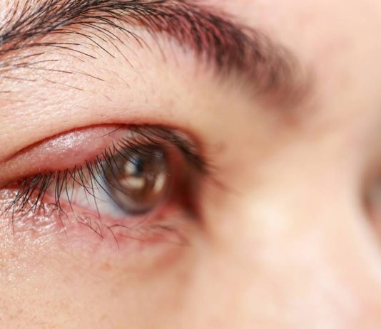 Why styes come out and how to cure them quickly with natural remedies Why styes come out and how to cure them quickly with natural remedies